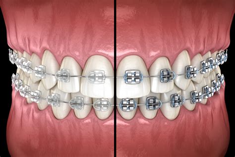 metal brackets vs ceramic|ceramic braces vs metal cost.